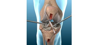 ACL_Reconstruction_Market