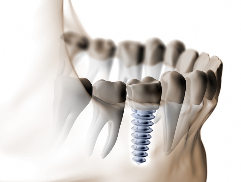 Dental_Implant_Simulation_Software_Market