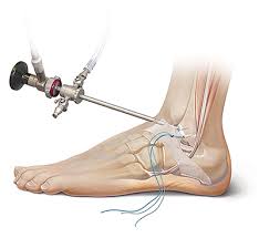 Foot_and_Ankle_Allograft