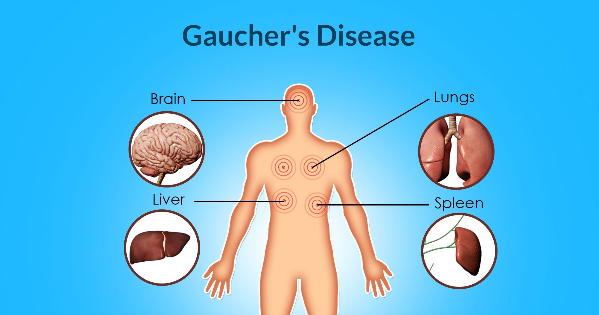 Gaucher_and_Pompe_Diseases_Enzyme_Replacement_Therapy_(ERT)_Market