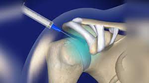 Joint_Pain_Injections