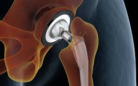 Knee_and_Hip_Replacement
