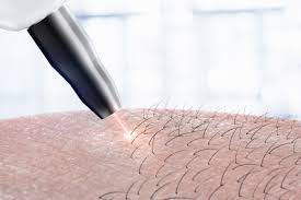 Laser_Hair_Removal1