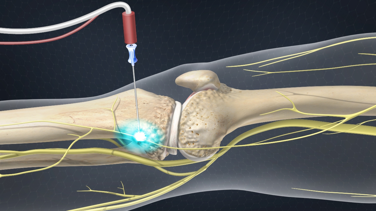 Radiofrequency_Ablation_Devices