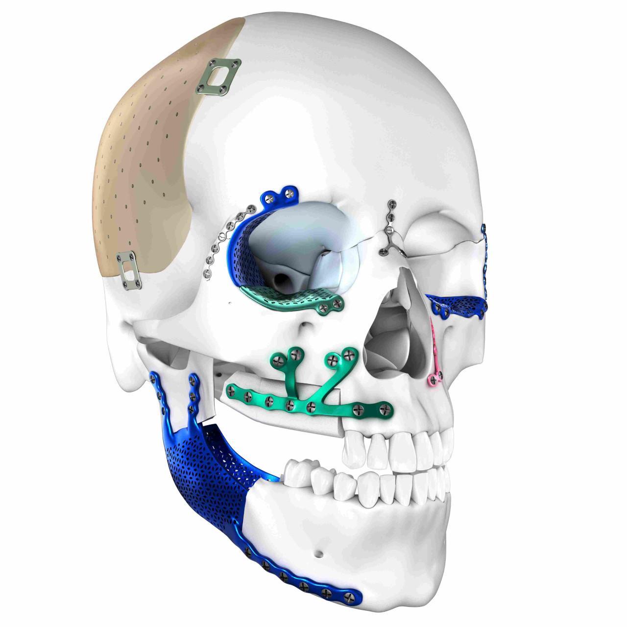 Skull_Deformity_Implants_Market