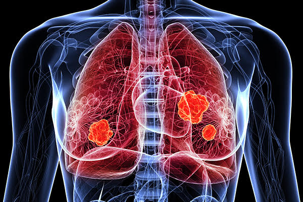 Small_Cell_Lung_Cancer_(SCLC)_Treatment_Market