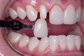 Temporization_Material_for_Dental