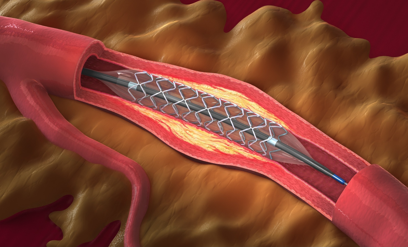 Peripheral_Vascular_Devices