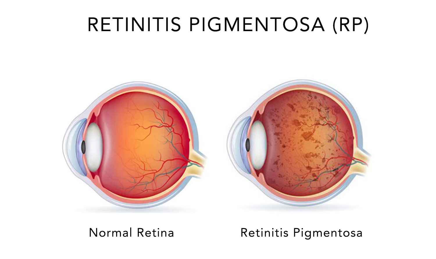 Retinitis_Pigmentosa_Treatment