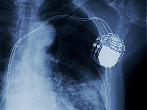cardiac_pacemakers_market